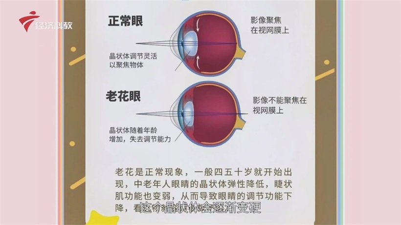 聚焦东莞老花眼治疗：张晓山教授带来行业新洞察(图2)
